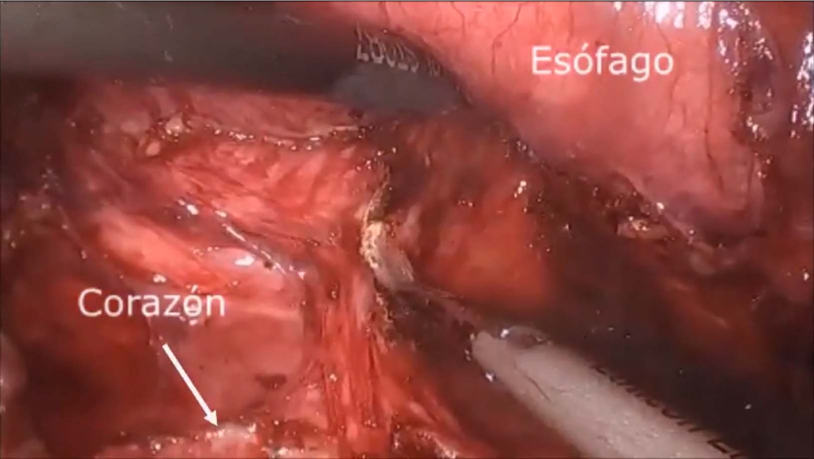 ESOFAGECTOMÍA DE TRES CAMPOS